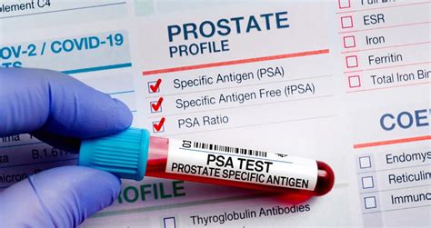 does alcohol affect psa test|Alcohol consumption and PSA.